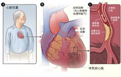 冠心病的起因是什么？