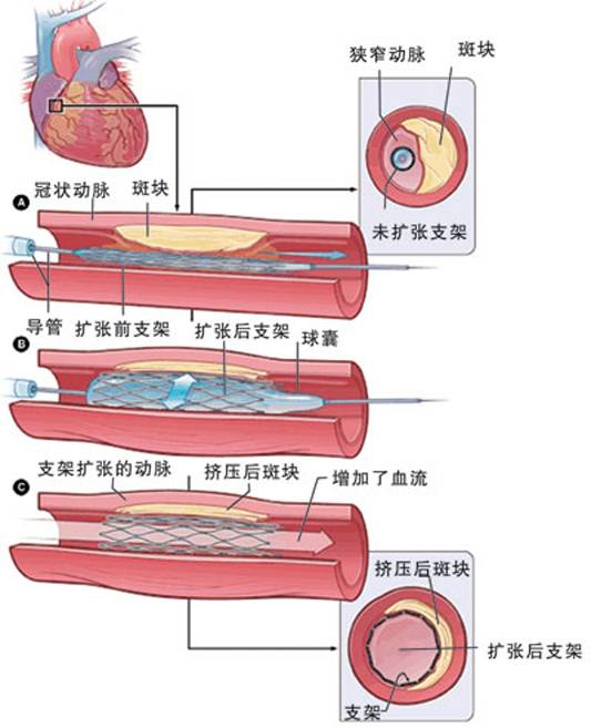 怎樣治療冠心?。?圖2)